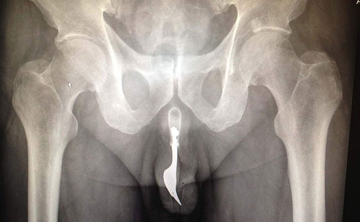 xray with penis