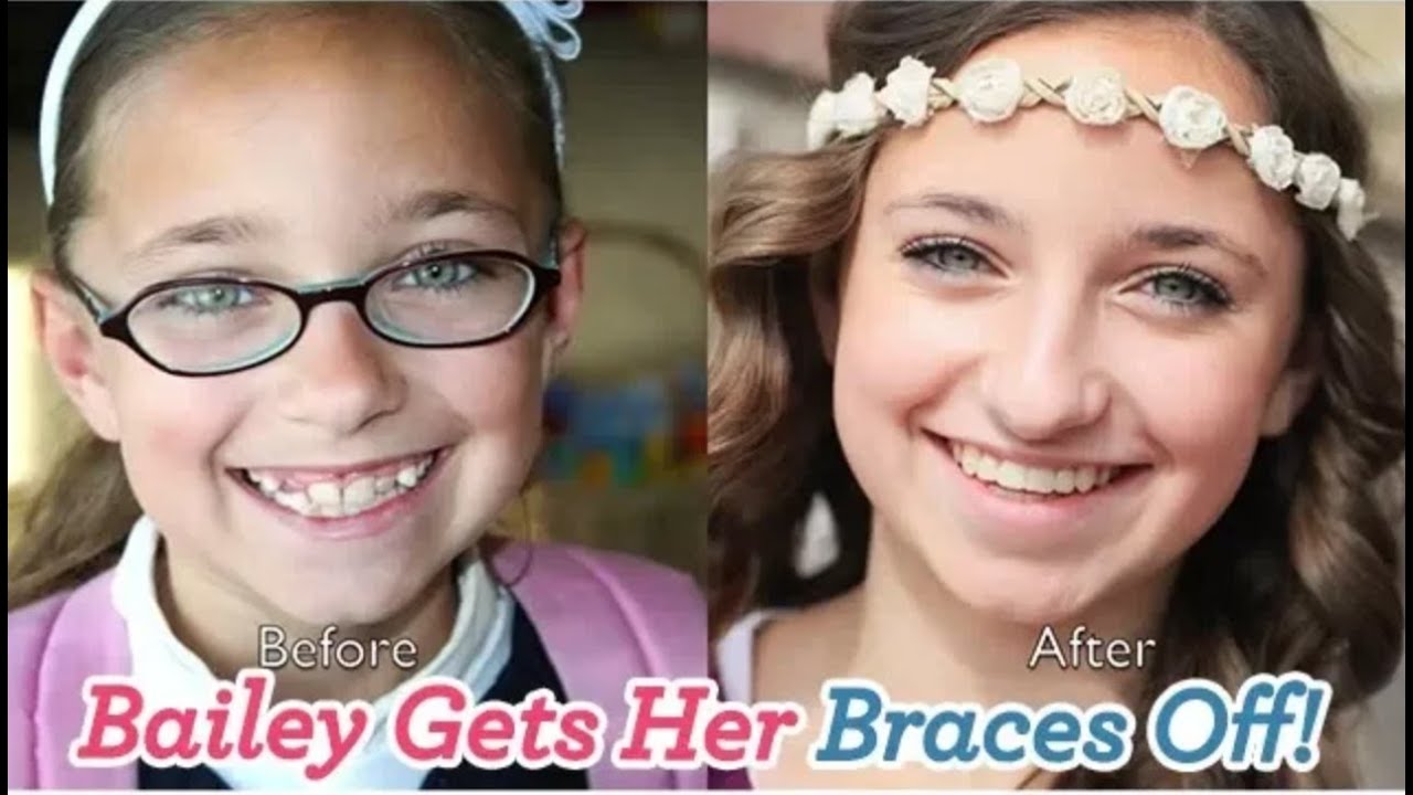 Best of Brooklyn and bailey braces