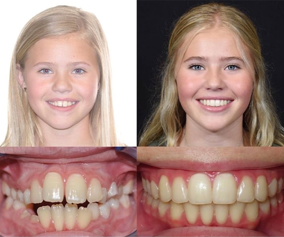 dennis manguiat add photo brooklyn and bailey braces