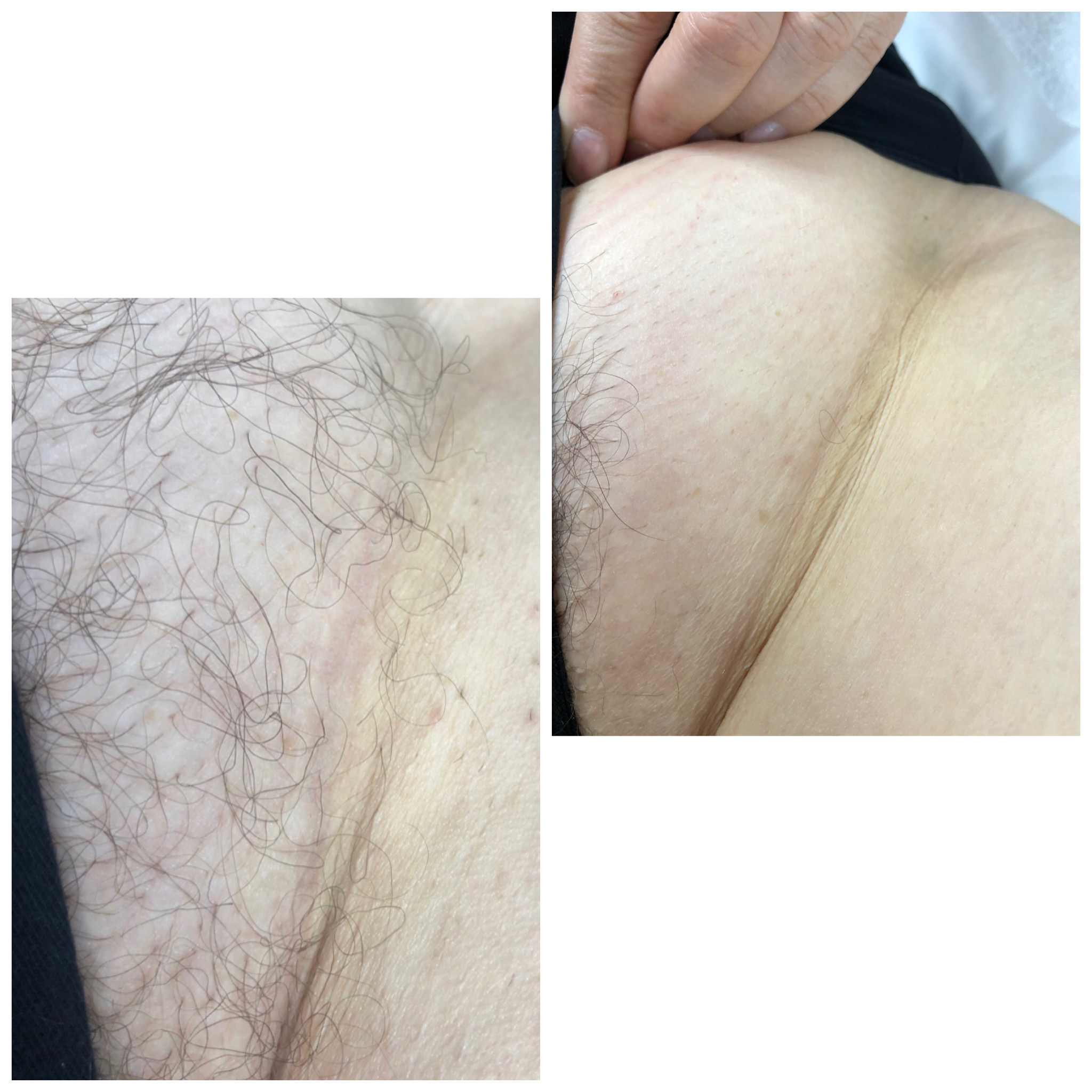 colin teo recommends Brazilian Wax Before And After Pictures