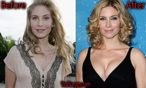 amy guenette recommends elizabeth mitchell boob job pic