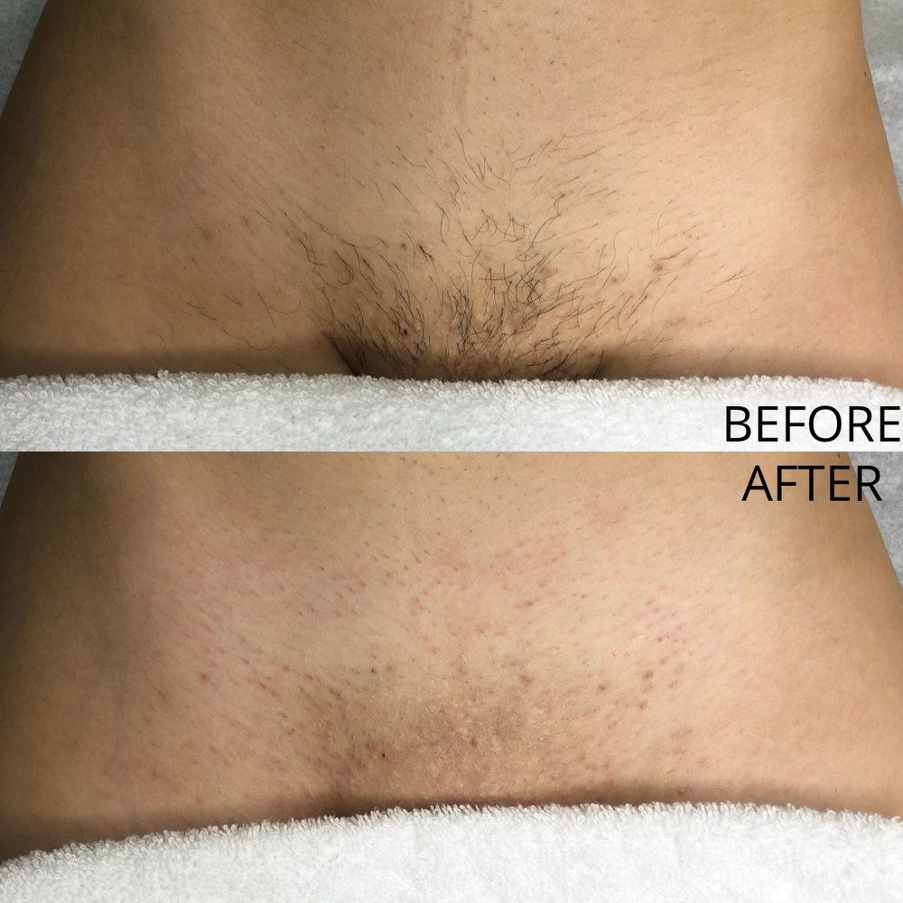 alisha brennan recommends Brazilian Wax Before And After Pictures