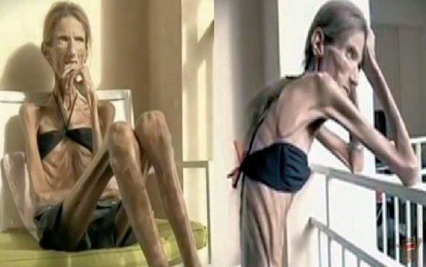 ann fox add skinniest woman in the world photo