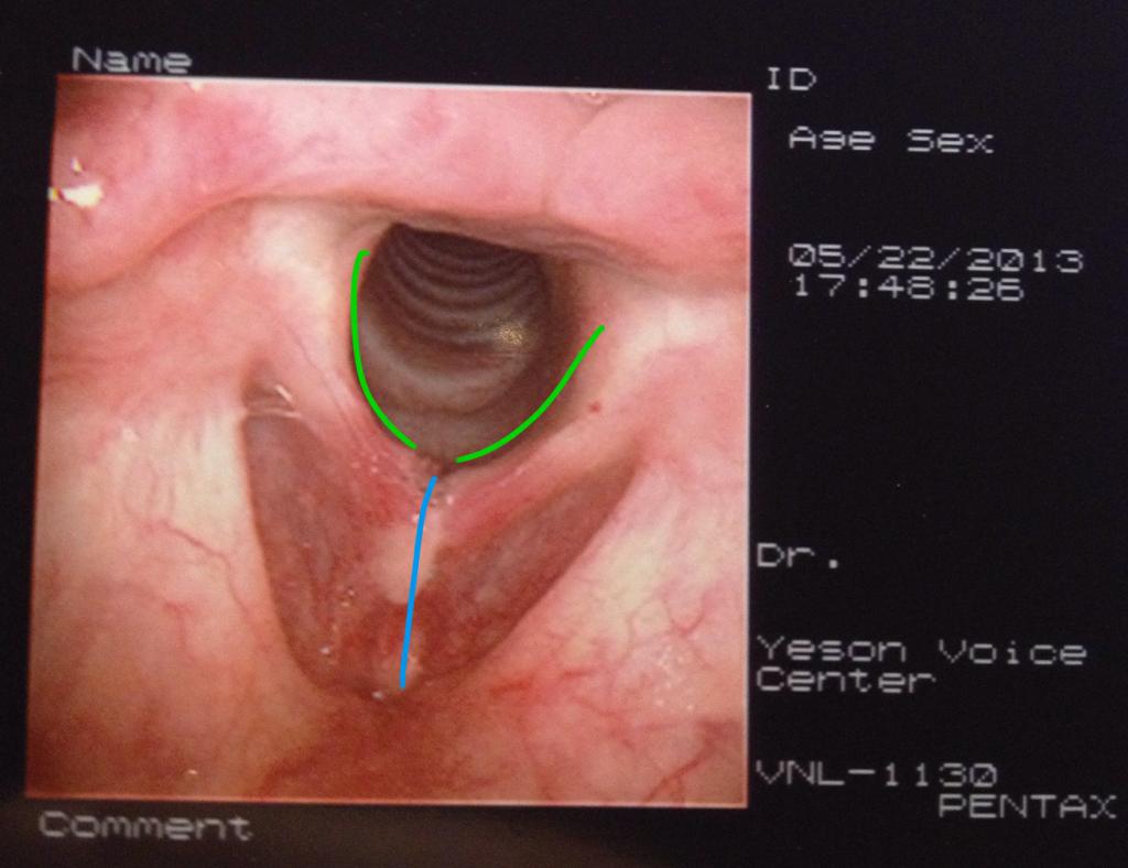 angela macdonald recommends transsexual post op pics pic