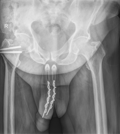 Xray With Penis pole dance