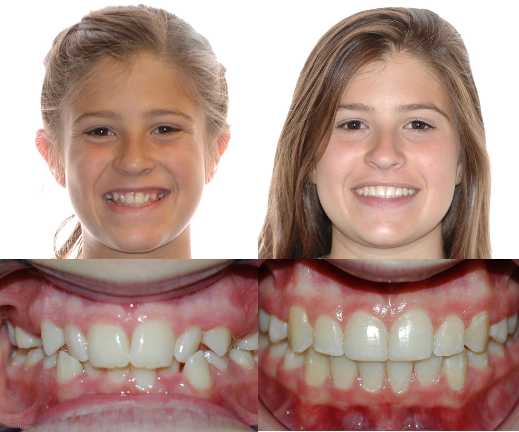 christine buist recommends Brooklyn And Bailey Braces