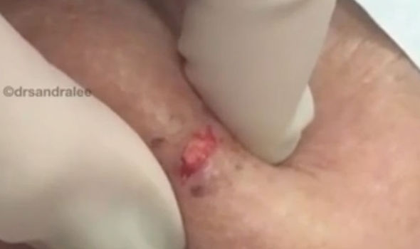 dot blanchard recommends popping pimples in private area video pic
