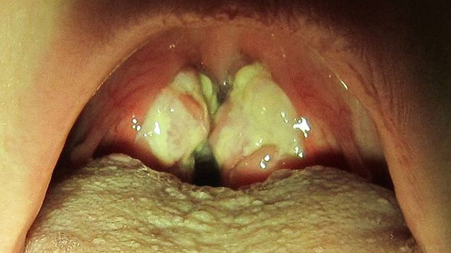 andrea cassells recommends sore throat from deep throat pic