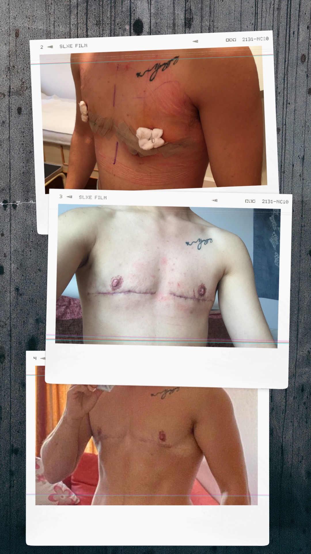 cindy gallimore recommends Post Op Shemale Pics