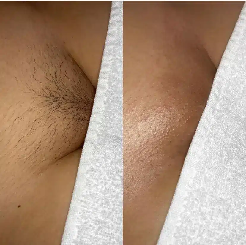 abdelkarim mohamed recommends brazilian wax before and after pictures pic