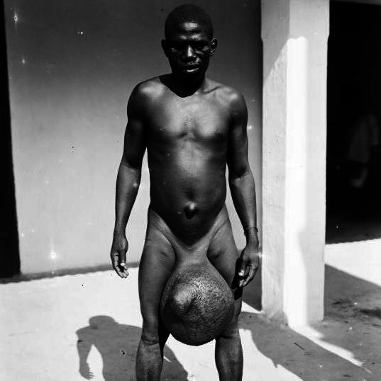 charles edward cotton recommends elephantiasis of the balls pic