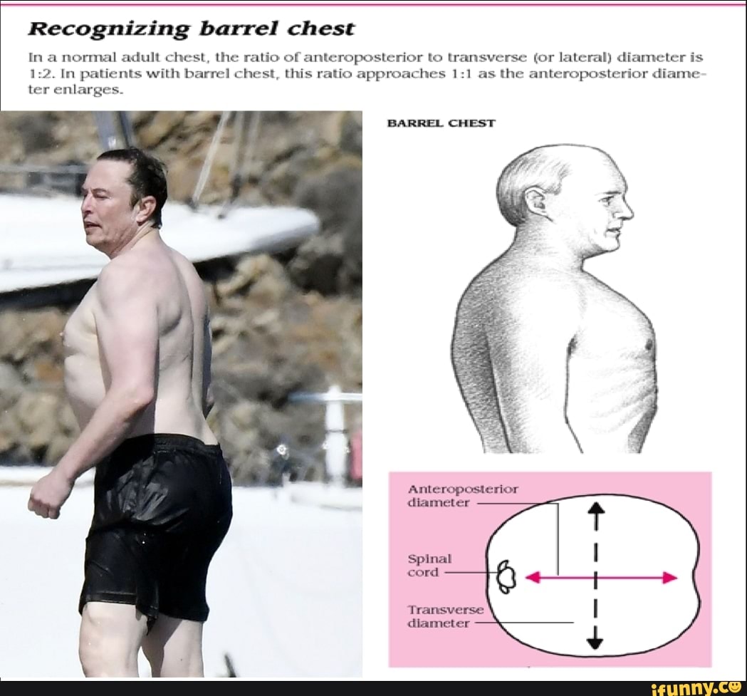 dana tice recommends Is A Barrel Chest Attractive