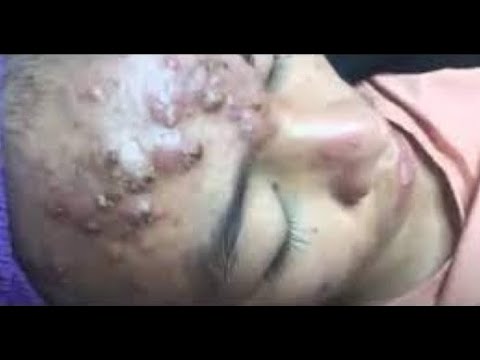 amber lamberth add popping pimples in private area video photo