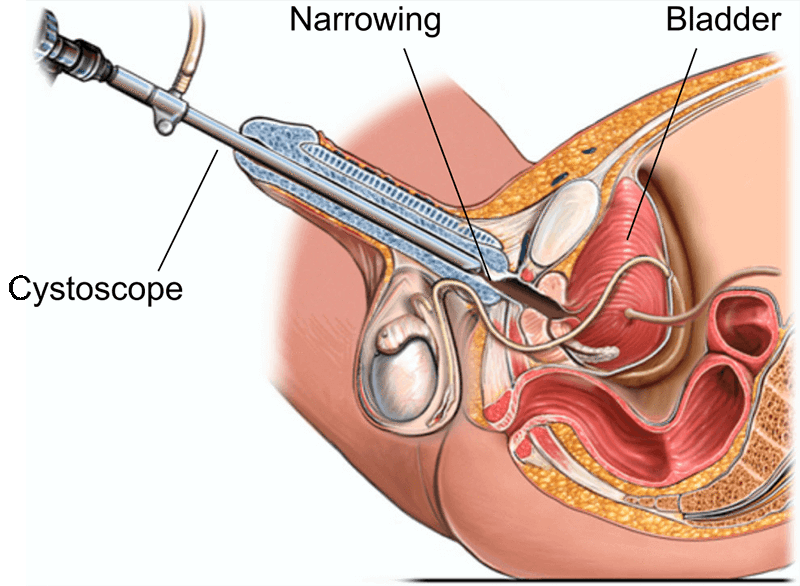 pumping air into urethra