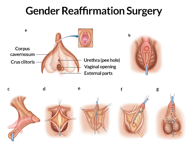 al geronimo recommends Transsexual Post Op Pics